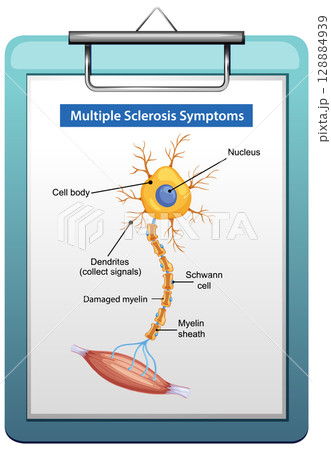 Labeled Diagram of Nerve Cell in Multiple Sclerosis 128884939