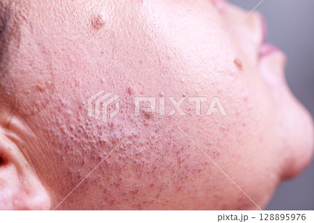 Skin face after removing hair Skin face after removing hair 128895976