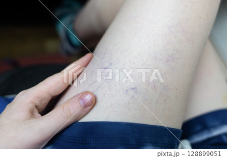 Close up image of spider veins on a womans leg during a medical examination. Visible varicose capillaries, teleangiectasia, or vascular stars. Concept of venous disease, pregnancy aftermath Close up image of spider veins on a womans leg during a medical examination. Visible varicose capillaries, teleangiectasia, or vascular stars. Concept of venous disease, pregnancy aftermath 128899051