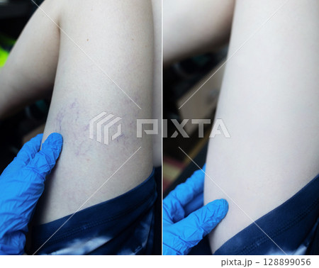 Close up image of spider veins on a womans leg during a medical examination. Visible varicose capillaries, teleangiectasia, or vascular stars. Concept of venous disease, pregnancy aftermath 128899056