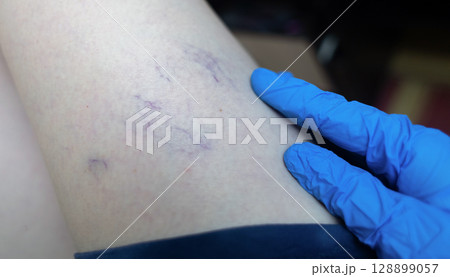 Close up image of spider veins on a womans leg during a medical examination. Visible varicose capillaries, teleangiectasia, or vascular stars. Concept of venous disease, pregnancy aftermath 128899057