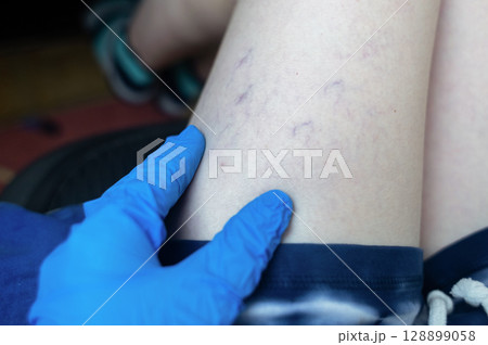 Close up image of spider veins on a womans leg during a medical examination. Visible varicose capillaries, teleangiectasia, or vascular stars. Concept of venous disease, pregnancy aftermath 128899058