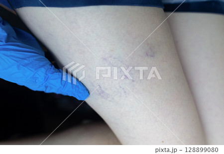 Close up image of spider veins on a womans leg during a medical examination. Visible varicose capillaries, teleangiectasia, or vascular stars. Concept of venous disease, pregnancy aftermath 128899080