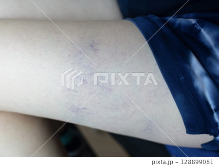 Close up image of spider veins on a womans leg during a medical examination. Visible varicose capillaries, teleangiectasia, or vascular stars. Concept of venous disease, pregnancy aftermath 128899081