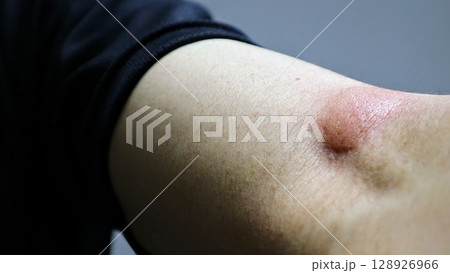 蚊に刺された腕のクローズアップ 蚊に刺された腕のクローズアップ 128926966