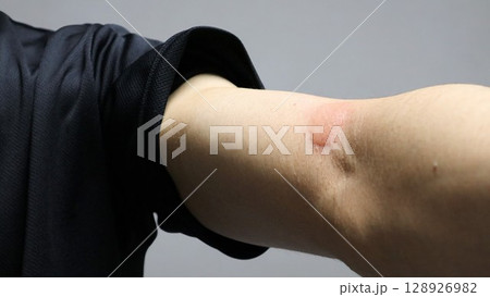 蚊に刺された腕のクローズアップ 蚊に刺された腕のクローズアップ 128926982