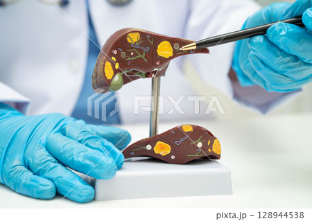 Cirrhosis, Liver cancer, fatty liver, Asian doctor with liver human anatomy model in World Hepatitis Day at hospital. 128944538