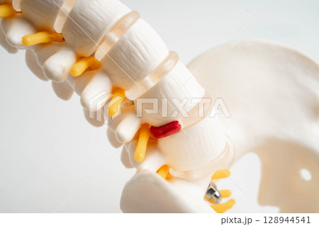 Spinal nerve and bone, Lumbar spine displaced herniated disc fragment, Model for treatment medical in the orthopedic department. Spinal nerve and bone, Lumbar spine displaced herniated disc fragment, Model for treatment medical in the orthopedic department. 128944541