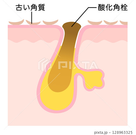 酸化角栓と古い角質　角栓の詰まった毛穴　断面図 128963325
