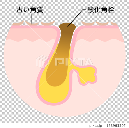 Oxidized keratin plugs and old keratin plugs - Cross-section of a pore clogged with keratin plugs Oxidized keratin plugs and old keratin plugs - Cross-section of a pore clogged with keratin plugs 128963395