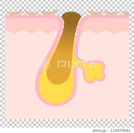 Oxidized keratin plugs and old keratin plugs - Cross-section of a pore clogged with keratin plugs 128970082