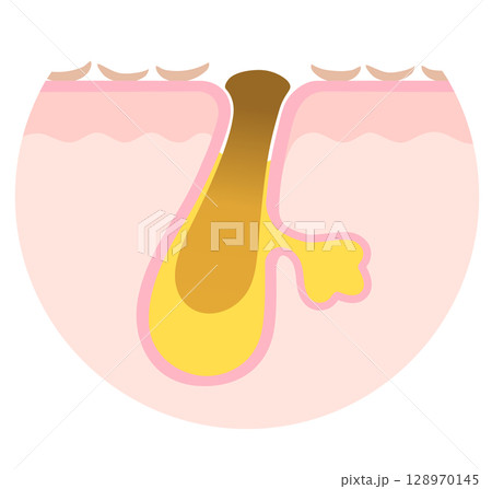 酸化角栓と古い角質　角栓の詰まった毛穴　断面図 128970145