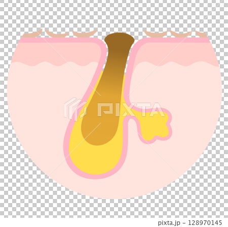 酸化角栓と古い角質　角栓の詰まった毛穴　断面図 128970145