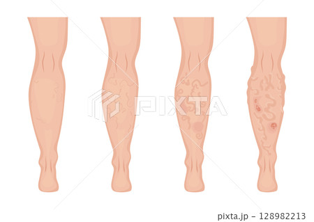 Stages of varicose veins developing on human leg Stages of varicose veins developing on human leg 128982213