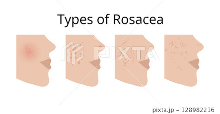 Four types of rosacea showing different symptoms on face skin Four types of rosacea showing different symptoms on face skin 128982216