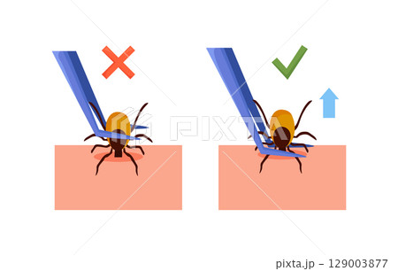 Removing encephalitis ticks after bite. How to remove mite. Parasite carrying disease. Tick grabbed into skin, it is removed with tweezers. First aid. Prevention of infections transmitted by mites Removing encephalitis ticks after bite. How to remove mite. Parasite carrying disease. Tick grabbed into skin, it is removed with tweezers. First aid. Prevention of infections transmitted by mites 129003877