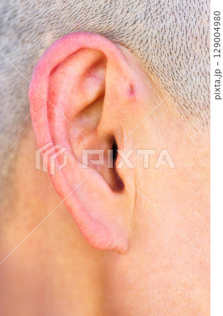 A preauricular sinus appears as a very small pit just in front of the external ear, these sinuses can drain a foul smelling discharge, and when this happens, they are prone to chronic infection. 129004980