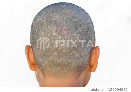 Rear view of bald woman head Rear view of bald woman head 129004983