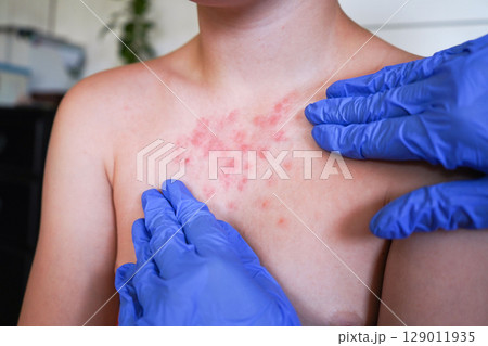 The boy's skin rash appears to be allergic in origin. 129011935
