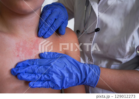 The boy's skin condition suggests an allergic reaction. The boy's skin condition suggests an allergic reaction. 129012273