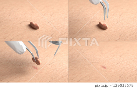 Skin surface with papilloma laser removal treatment process macro 129035579