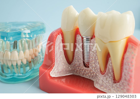 Dental implant, artificial tooth roots into jaw, root canal of dental treatment, gum disease, teeth model for dentist studying about dentistry. 129048303
