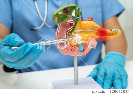 Pancreatitis, pancreatic cancer, Asian doctor with pancreas, gallbladder and bile duct human anatomy model at hospital. 129082024