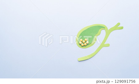 Gallbladder with gallstones (cholelithiasis) anatomy made from paper on blue background. Gallstone blocks the flow of bile through your biliary system causing cholecystitis, pancreatitis, cholangitis. Gallbladder with gallstones (cholelithiasis) anatomy made from paper on blue background. Gallstone blocks the flow of bile through your biliary system causing cholecystitis, pancreatitis, cholangitis. 129091756
