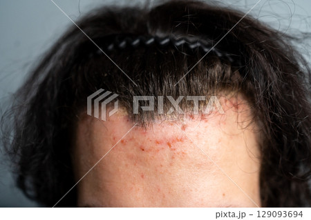 Close-up of a person s forehead with acne and irritation along the hairline, wearing a black hairband. Concept of skin problems, scalp issues, and dermatological care. Close-up of a person s forehead with acne and irritation along the hairline, wearing a black hairband. Concept of skin problems, scalp issues, and dermatological care. 129093694