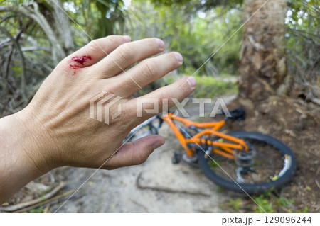 Bike rider hand injury with red blood from hitting a tree stump. Mountain biking accident 129096244