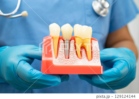 Dentist holding dental implant, artificial tooth roots into jaw, root canal of dental treatment, gum disease, teeth model for dentist. Dentist holding dental implant, artificial tooth roots into jaw, root canal of dental treatment, gum disease, teeth model for dentist. 129124144