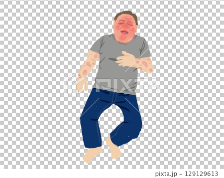 Man in anaphylactic shock/Symptoms of hives and facial flushing Man in anaphylactic shock/Symptoms of hives and facial flushing 129129613