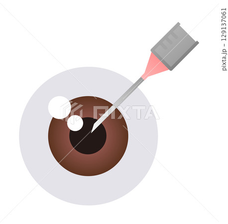 老化や疾患による目の病気になり眼科で手術をして治療するイラスト 老化や疾患による目の病気になり眼科で手術をして治療するイラスト 129137061
