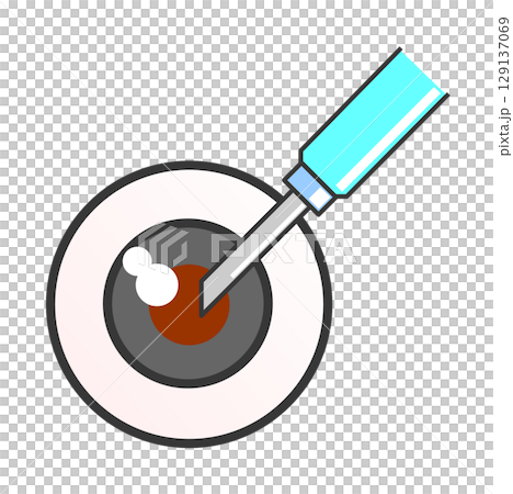 Illustration of eye disease caused by aging or disease, treated by surgery at an ophthalmology clinic 129137069