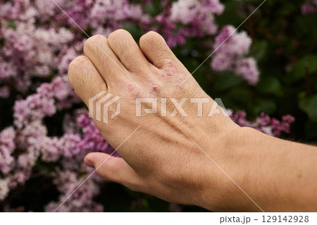 A closeup view of a hand exhibiting a skin condition set against a vibrant floral background 129142928