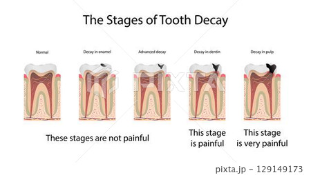 illustration of biology and medical, The stages of tooth decay, Tooth decay is damage that occurs to teeth, Dental plaque is important to the tooth decay process 129149173