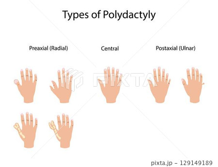 illustration of biology and medical, Types of polydactyly, Symptoms of Polydactyly, polydactyly is an anomaly in humans and animals resulting in supernumerary fingers or toes illustration of biology and medical, Types of polydactyly, Symptoms of Polydactyly, polydactyly is an anomaly in humans and animals resulting in supernumerary fingers or toes 129149189