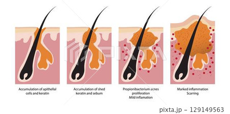 illustration of biology and medical, Clogged pores are a common skin concern that may lead to acne, Skin problems, acne, pimples and clogged pores, swelling, pain and irritation deep in the skin illustration of biology and medical, Clogged pores are a common skin concern that may lead to acne, Skin problems, acne, pimples and clogged pores, swelling, pain and irritation deep in the skin 129149563