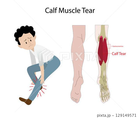 illustration of biology and medical, calf tear and Torn Calf Muscle, A torn calf muscle is an injury that causes a partial or complete tear in the muscles behind shin bone illustration of biology and medical, calf tear and Torn Calf Muscle, A torn calf muscle is an injury that causes a partial or complete tear in the muscles behind shin bone 129149571