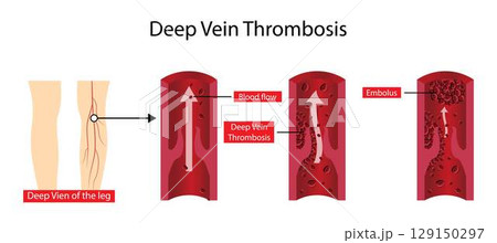 illustration of biology and medical, Deep vein thrombosis can cause leg pain or swelling, Deep vein thrombosis occurs when a blood clot forms in one or more of the deep veins in the body 129150297