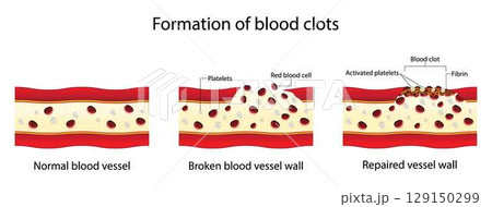 illustration of Biology and medical, Formation of blood clots, Blood clotting normally occurs when there is damage to a blood vessel, A platelet plug is formed, and the external bleeding stops 129150299