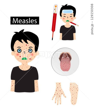 illustration of biology and medical, Measles, infectious disease, Measles is a highly contagious infectious disease caused by measles virus, spots may form inside the mouth after the start of symptoms 129150308