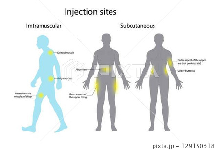 illustration of biology and medical, Several different sites can support an insulin injection, Insulin injection techniques, four sites on your body that can be used to give an intramuscular injection illustration of biology and medical, Several different sites can support an insulin injection, Insulin injection techniques, four sites on your body that can be used to give an intramuscular injection 129150318