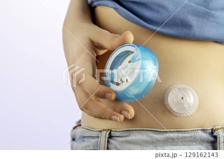 Installation of a diabetic injection port for insulin injections. The child installs an injection port for himself. Diabetes concept. Closeup 129162143