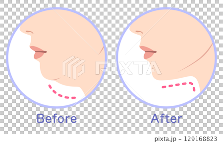 Double chin and slimmer chin - before and after 129168823