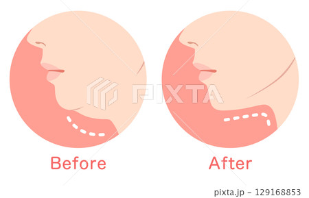 二重あごとスッキリしたあご ビフォーアフター 二重あごとスッキリしたあご ビフォーアフター 129168853