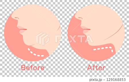 二重あごとスッキリしたあご ビフォーアフター 二重あごとスッキリしたあご ビフォーアフター 129168853
