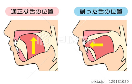 正しいミューイングの方法　適正な舌の位置と誤った舌の位置 129181029