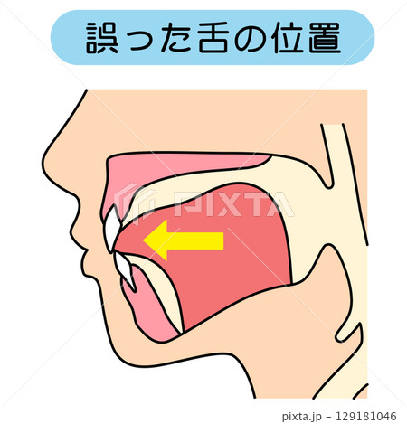 正しいミューイングの方法　適正な舌の位置と誤った舌の位置 129181046