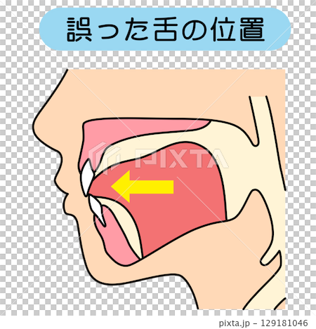 正しいミューイングの方法　適正な舌の位置と誤った舌の位置 129181046